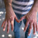 What You Should Know About Monkeypox