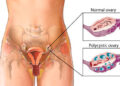 From PCOS to PMOS: Why Experts Are Renaming Polycystic Ovary Syndrome
