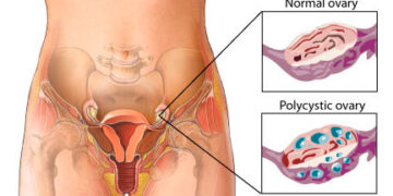 From PCOS to PMOS: Why Experts Are Renaming Polycystic Ovary Syndrome