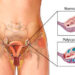 From PCOS to PMOS: Why Experts Are Renaming Polycystic Ovary Syndrome